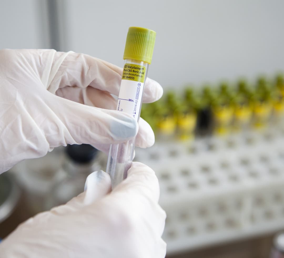 საქართველოში კორონავირუსით 24 საათში 21 ადამიანი გარდაიცვალა