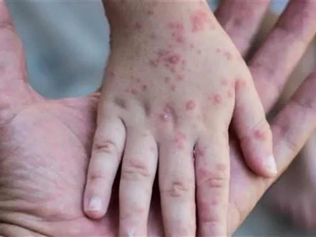 Georgia confirms first case of monkeypox virus
