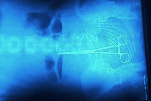 ოჯახის ინფორმაციით, ოპერაციის დროს 22 წლის გოგონას მუცლის ღრუში მაკრატელი ჩაუტოვეს